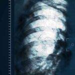 أشعة X Ray للصدر تصوير الصدر